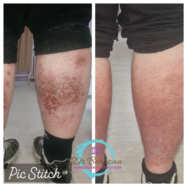 Dermatitis Coccica kod pacijenta