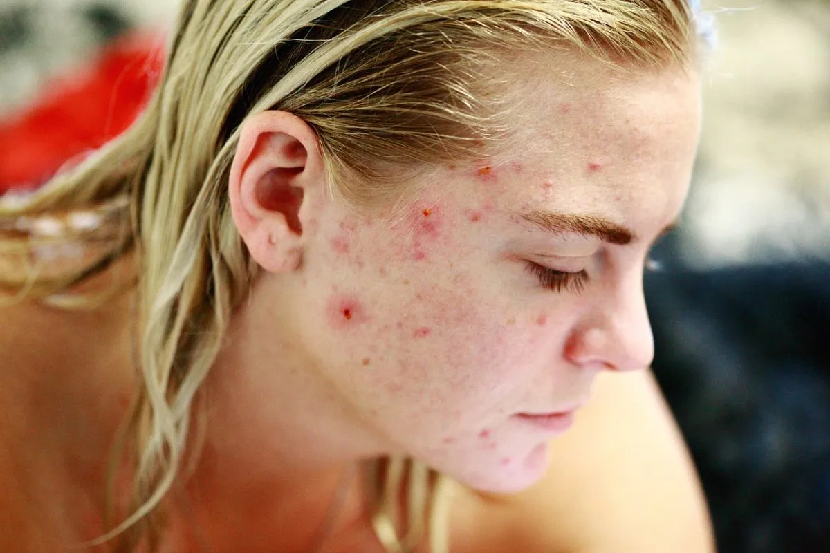 Acne Vulgaris: Uzroci, Simptomi i Savremene Metode Lečenja