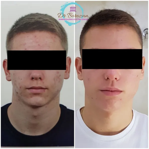 Rezultat tretmana pre i posle